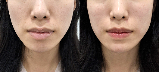 before & after
