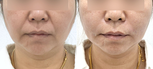 before & after