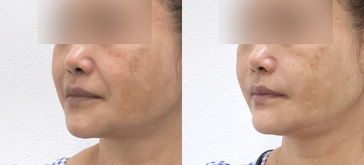before & after