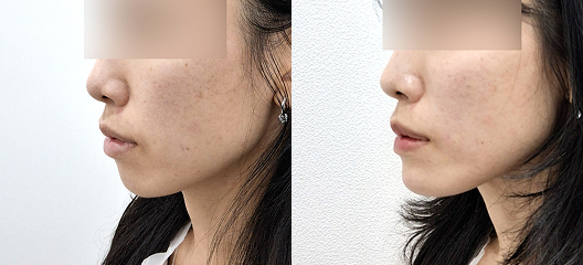 before & after
