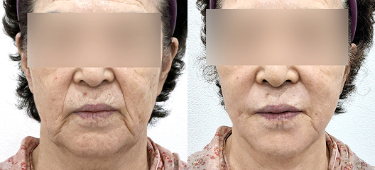 before & after