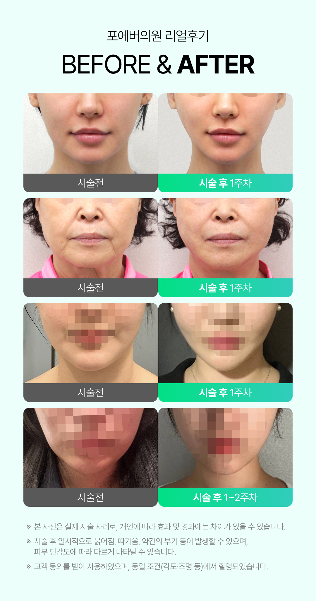 민트실리프팅